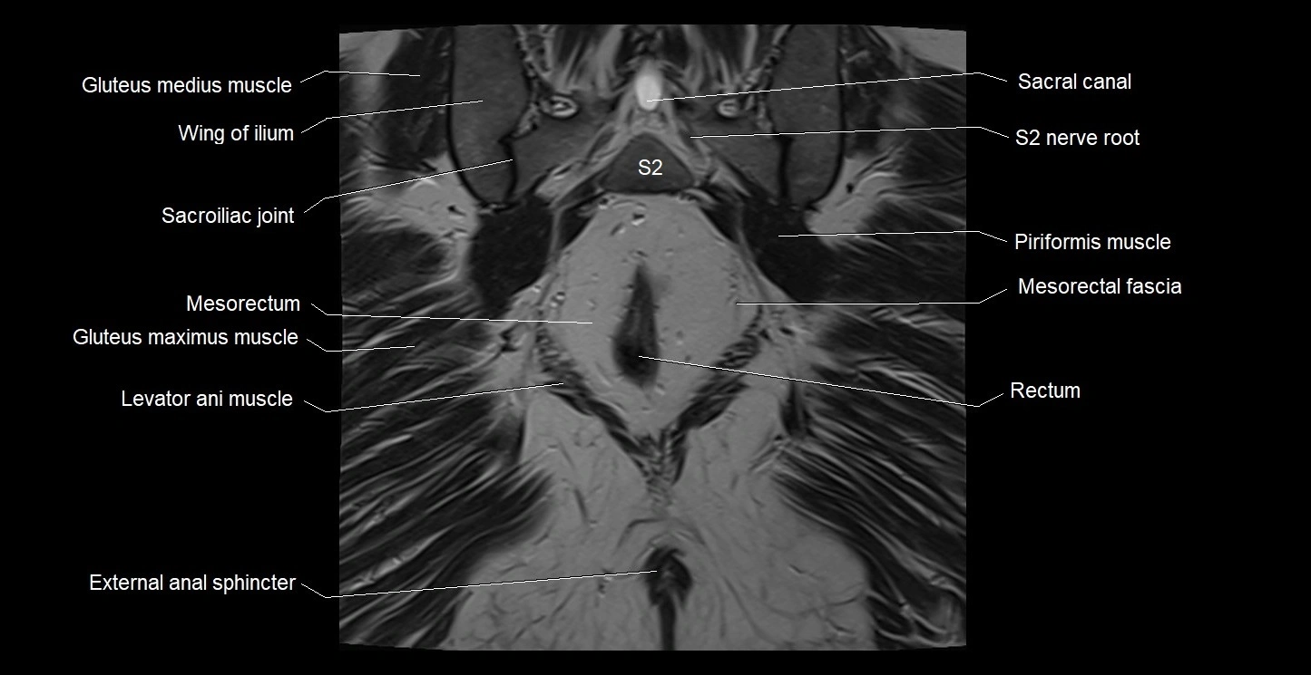 MRI coronal cross sectional anatomy male pelvis image 34.webp